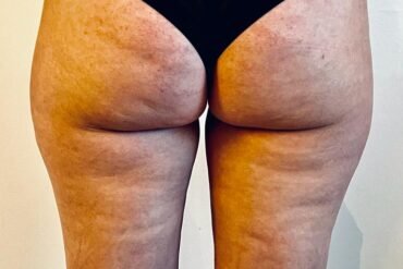 Ontdek de Kracht van Transformational Cupping bij Cupping Barneveld