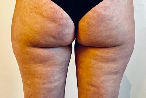 cupping, cellulitis, bindweefselmassage, transformeren, therapie, ontspanning, gezondheid, wellness, lichaamsbehandeling, zelfzorg, holistisch, spieren, rugpijn, nekpijn, stress, sportprestaties, genezing, acupunctuur, traditionele Chinese geneeskunde, energiestroom, littekens, bloedcirculatie, gifstoffen, immuunsysteem, verjonging, herstel, doorbloeding, massage, ontgifting, meridianen, ontsteking, pijnverlichting, alternatieve geneeskunde, natuurlijke genezing, helende kracht, chronische pijn, gezonde huid, vermoeidheid, slaapstoornissen, fibromyalgie, gewrichtspijn, menstruatiekrampen, spijsverteringsproblemen, hoofdpijn, migraine, allergieën, ademhaling, mindfulness, ontspanningstechnieken, meditatie, wellnesscentrum, cupping barneveld