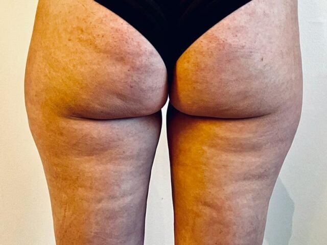 cupping, cellulitis, bindweefselmassage, transformeren, therapie, ontspanning, gezondheid, wellness, lichaamsbehandeling, zelfzorg, holistisch, spieren, rugpijn, nekpijn, stress, sportprestaties, genezing, acupunctuur, traditionele Chinese geneeskunde, energiestroom, littekens, bloedcirculatie, gifstoffen, immuunsysteem, verjonging, herstel, doorbloeding, massage, ontgifting, meridianen, ontsteking, pijnverlichting, alternatieve geneeskunde, natuurlijke genezing, helende kracht, chronische pijn, gezonde huid, vermoeidheid, slaapstoornissen, fibromyalgie, gewrichtspijn, menstruatiekrampen, spijsverteringsproblemen, hoofdpijn, migraine, allergieën, ademhaling, mindfulness, ontspanningstechnieken, meditatie, wellnesscentrum, cupping barneveld