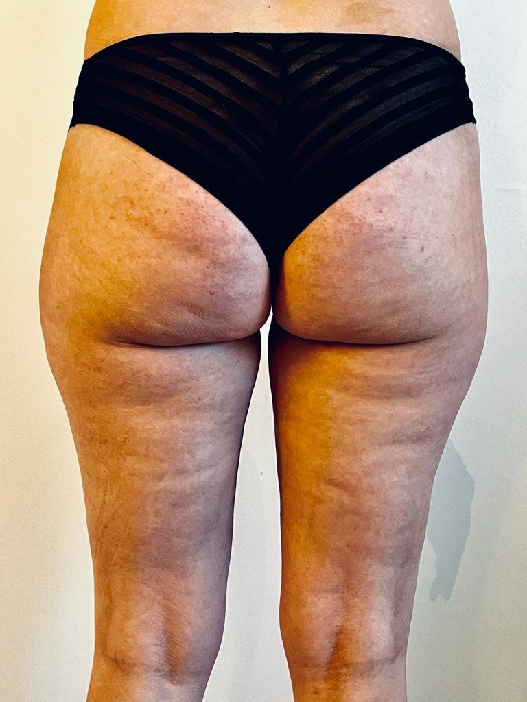 cupping, cellulitis, bindweefselmassage, transformeren, therapie, ontspanning, gezondheid, wellness, lichaamsbehandeling, zelfzorg, holistisch, spieren, rugpijn, nekpijn, stress, sportprestaties, genezing, acupunctuur, traditionele Chinese geneeskunde, energiestroom, littekens, bloedcirculatie, gifstoffen, immuunsysteem, verjonging, herstel, doorbloeding, massage, ontgifting, meridianen, ontsteking, pijnverlichting, alternatieve geneeskunde, natuurlijke genezing, helende kracht, chronische pijn, gezonde huid, vermoeidheid, slaapstoornissen, fibromyalgie, gewrichtspijn, menstruatiekrampen, spijsverteringsproblemen, hoofdpijn, migraine, allergieën, ademhaling, mindfulness, ontspanningstechnieken, meditatie, wellnesscentrum, cupping barneveld