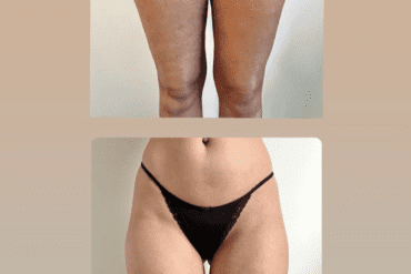 Bye Bye Cellulitis: Ontdek de Transformationele Kracht van Cupping!