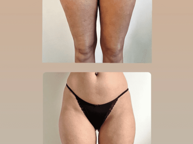 Persoon ondergaat cuppingtherapie voor cellulitis in haar benen bij Cupping Barneveld voor een gladdere en strakkere huid